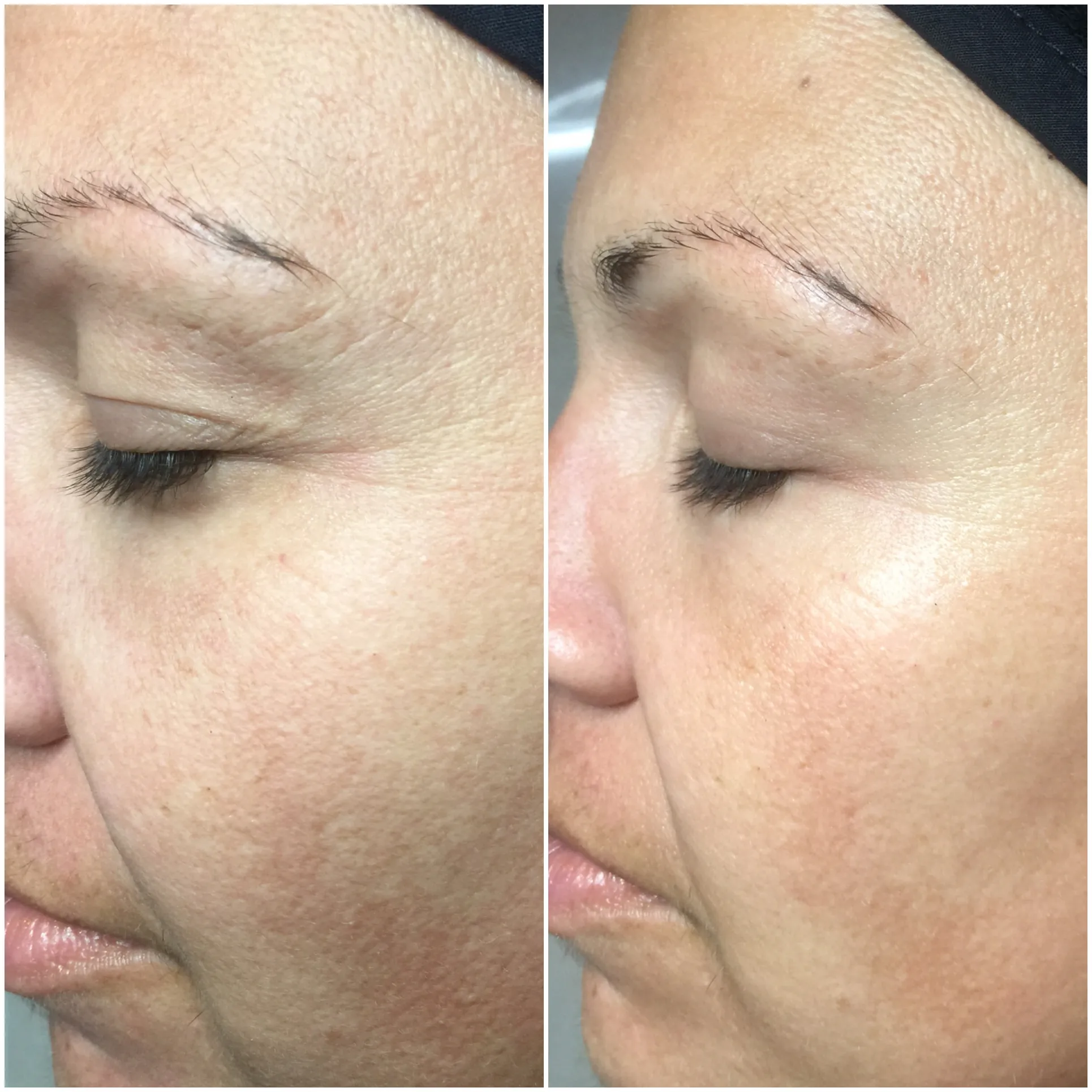 Wrinkle Reduction Park City