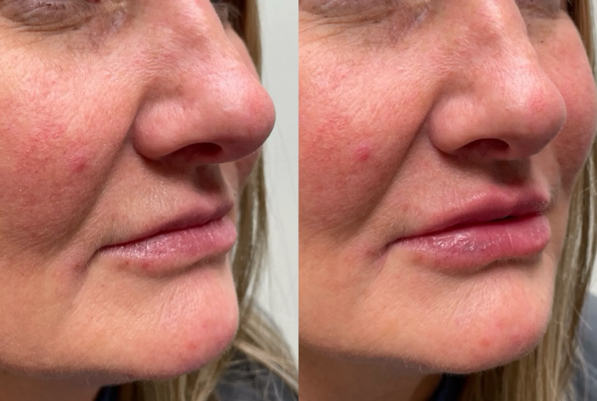 Lip Fillers Park City